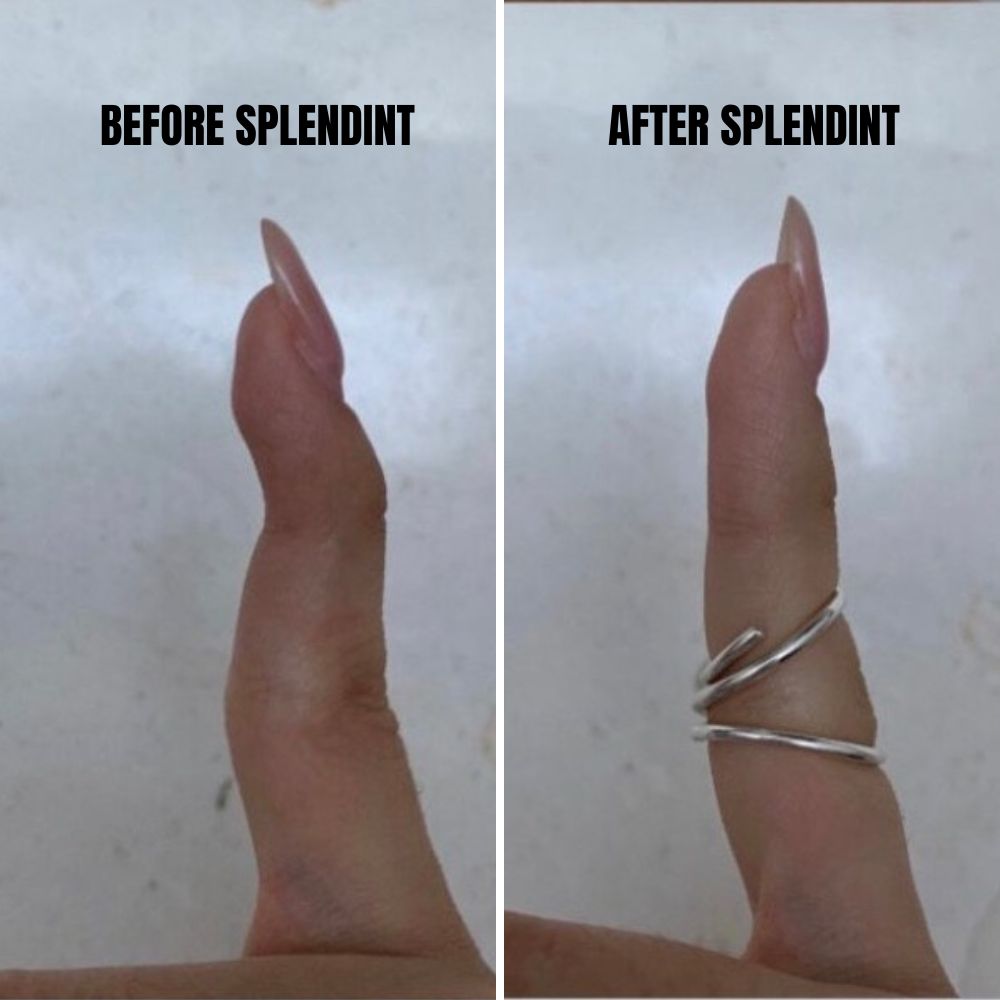 SPLENDINT - Works like a splint, looks like a ring